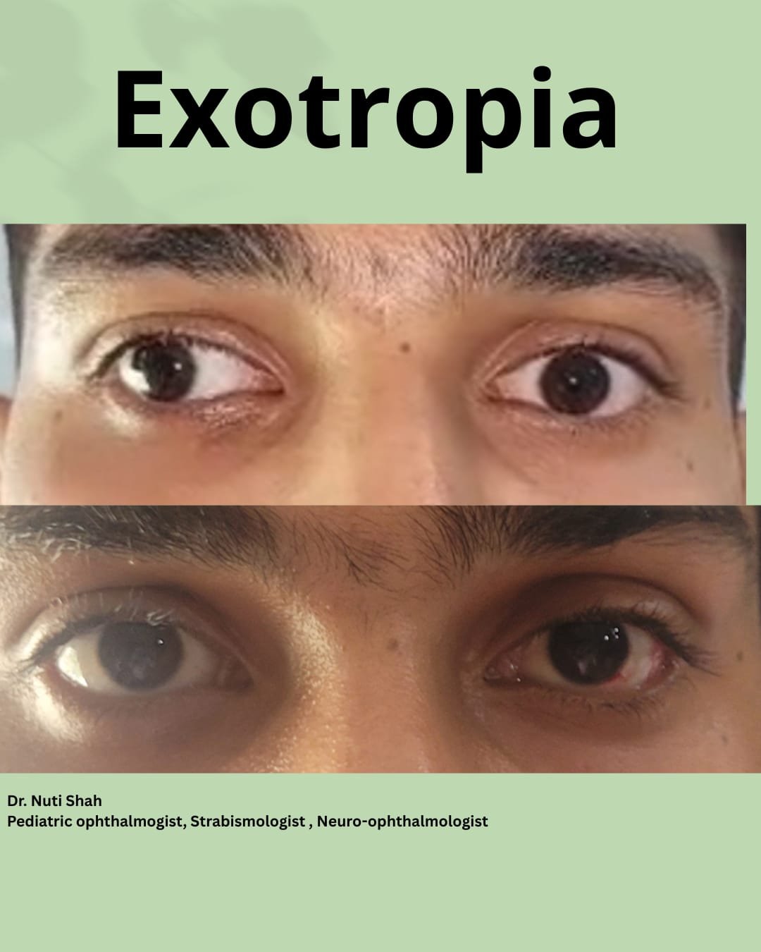Exotropia before and after treatment