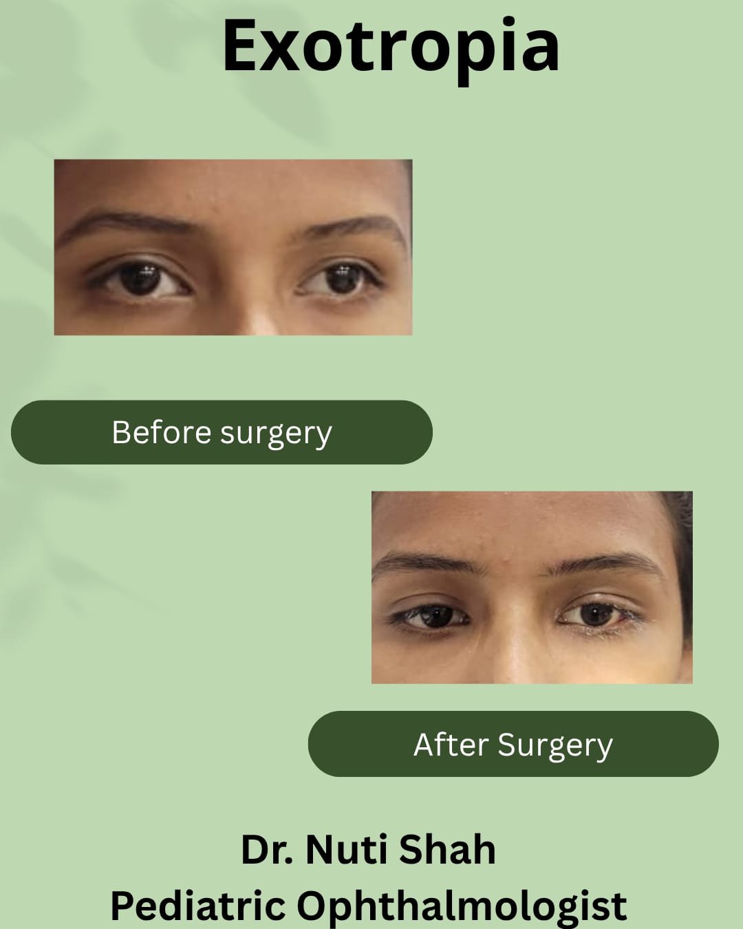 Exotropia treatment outcome