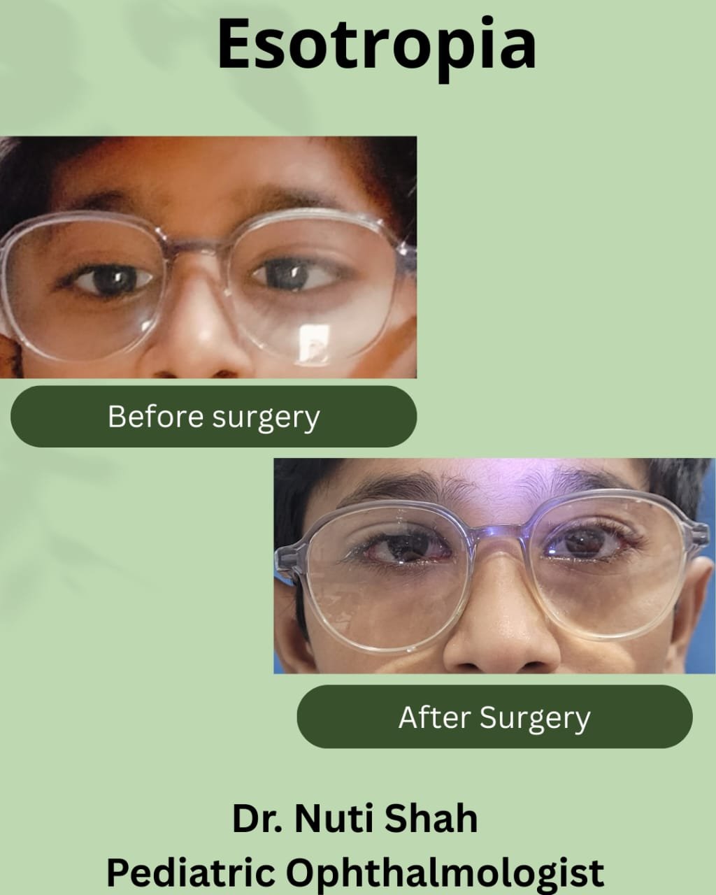 Esotropia treatment in child