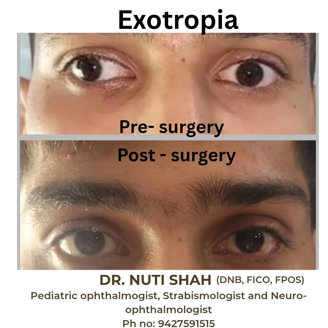 Exotropia pre and post squint surgery result
