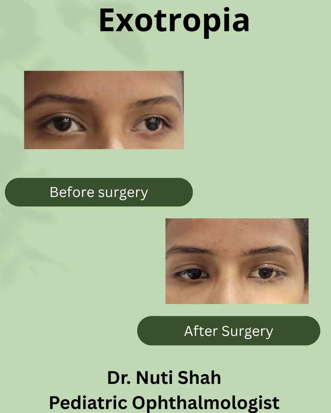 Exotropia squint treatment outcome